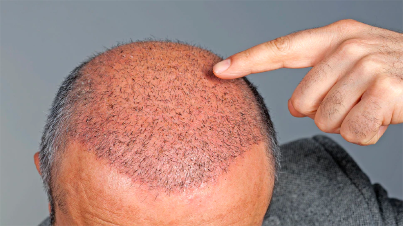 Hair Transplant के विज्ञापनों से हो जाएं सावधान, जांच में हुआ खुलासा