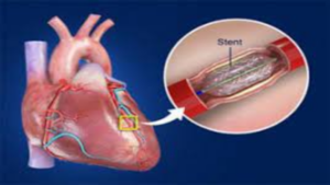 Shreyas Talpade Heart Attack: एंजियोप्लास्टी क्या है? जानें इसके उपचार