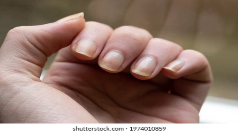 Nails Discoloration: जानें नाखूनों का रंग बदलना और बार-बार टूटना करता है किस बीमारी का इशारा