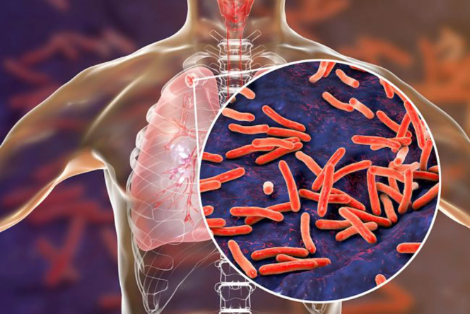 Tuberculosis: टीबी शोध में हुआ बड़ा खुलासा, 80 प्रतिशत से अधिक मरीजों में नहीं दिखा खांसी का लक्षण